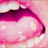 Лечение стоматита народной медициной