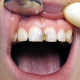 Кариес появился за несколько дней