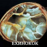 Симптомы лечение и профилактика эхинококкоза
