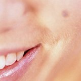 Придуманные мифы про опасность родинок