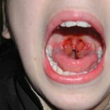 Опасность ангины для здоровья человека