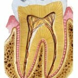Удаление нерва в зубе с помощью мышьяка
