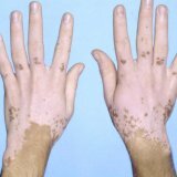 Белые пятна на коже причины