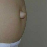 Пупочная грыжа у взрослых симптомы