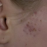 Удаление рубцов после прыщей домашними средствами