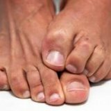 Паразитирующий грибок на коже человека