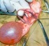 Доброкачественное заболевание фибромиома матки