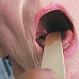 Народные средства для лечения хронического тонзиллита