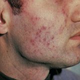 Как выглядит туберкулёз кожи человека