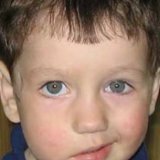 Массаж при неврите лицевого нерва