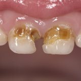 Основные причины кариеса у маленьких детей