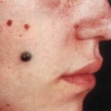 Развитие меланомы и лечение болезни