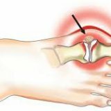 Способы и методы лечения подагры