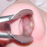 Заболевание хронический гипертрофический ринит