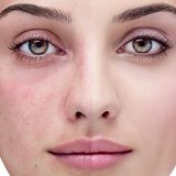 Лечение купероза на лице народными средствами