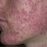 Себорейная патология кожи лица