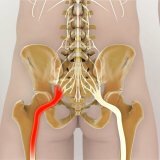 Лечение защемления седалищного нерва