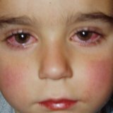 Глазные болезни лечение хронического коньюктивита