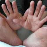 Ветряная оспа на ладонях и ступнях